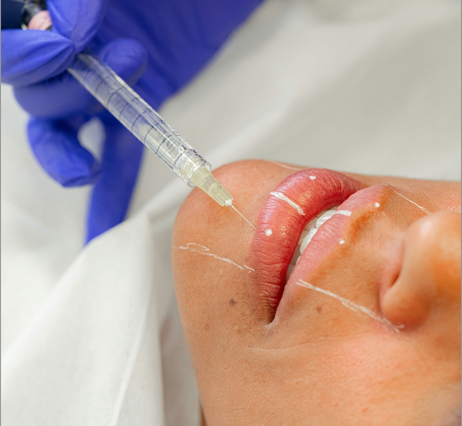 Lip Enhancement & Botox Maintenance